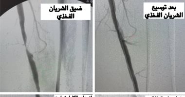 أونلي ليبانون : إنقاذ حياة 3 حالات بمستشفى القناطر الخيرية المركزى من بتر السيقان بجراحات عاجلة