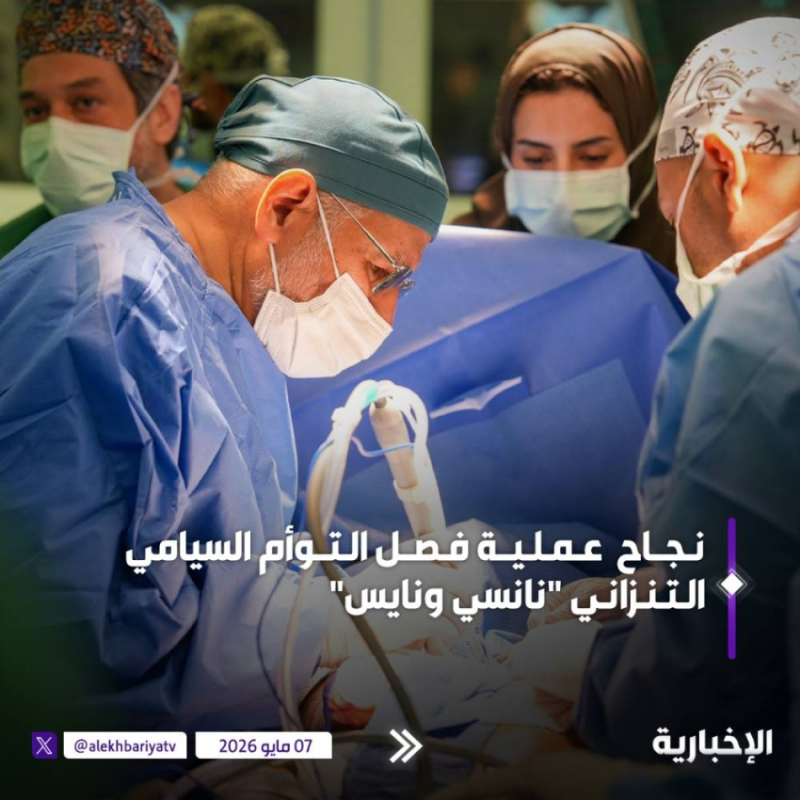 في إنجاز طبي جديد.. نجاح عملية فصل التوأم الملتصق التنزاني “نانسي ونايس”