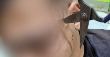 نجاح استخراج مقص من رأس شاب بمستشفى المنصورة الدولي