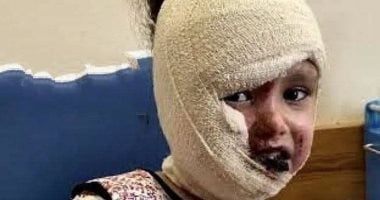 الحروق سرقت طفولتها.. ريتال حلاوة تواجه الألم داخل خيمة لا تقيها حر الصيف في غزة.. ارتفاع درجات الحرارة يحول المعاناة إلى عذاب يومي يضاعف جراح طفلة لم تتجاوز السادسة.. وتحمل حلما مؤجلا لطفولة تستحق الحياة