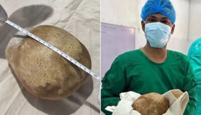 حصوة بوزن طفل داخل مثانته.. كيف عاش بها سنوات ولم يكتشفها؟ | منوعات
